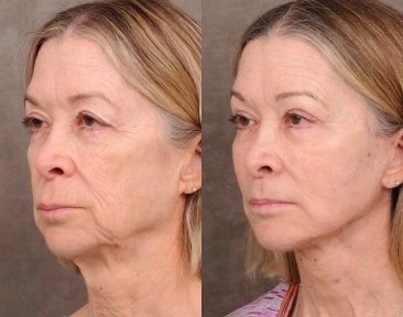 before-after photo tightening-of-facial-skin-facelift