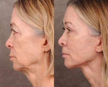 before-after photo tightening-of-facial-skin-facelift