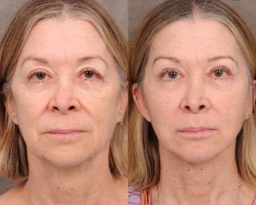 before-after photo tightening-of-facial-skin-facelift