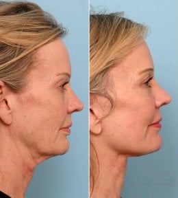 before-after photo tightening-of-facial-skin-facelift