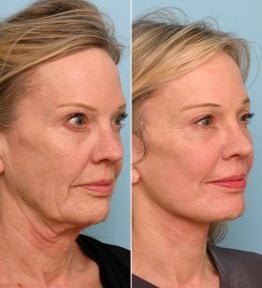 before-after photo tightening-of-facial-skin-facelift