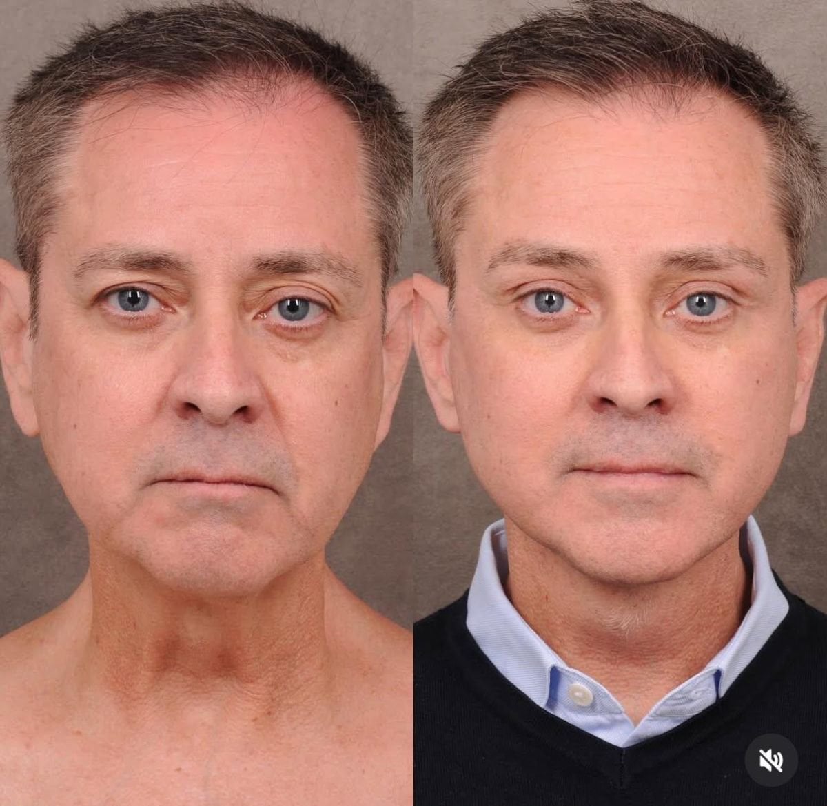Facelift before and after results at Dr. Alexandro Aguilera - Plastic Surgery, facial rejuvenation