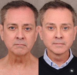before-after photo tightening-of-facial-skin-facelift