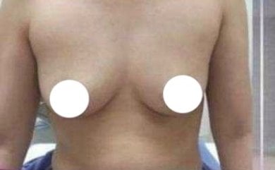Before breast augmentation at clinic – natural breast shape prior to enhancement procedure