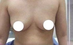 Before breast augmentation at clinic – natural breast shape prior to enhancement procedure