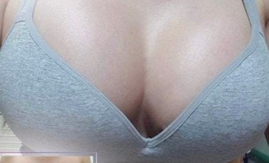 Breast augmentation result – enhanced breast size and shape after procedure