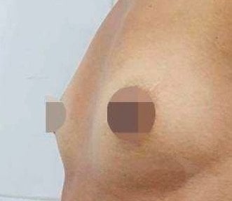 Breast augmentation before and after result – enhanced breast contour and volume