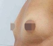 Breast augmentation before and after result – enhanced breast contour and volume