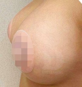 Breast augmentation result – enhanced breast shape and volume after procedure