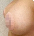 Breast augmentation result – enhanced breast shape and volume after procedure
