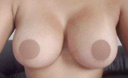 Breast augmentation result with fuller, natural-looking breasts after procedure
