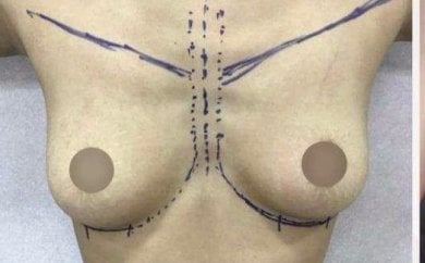 Preoperative markings for breast augmentation procedure, planning incision and implant placement