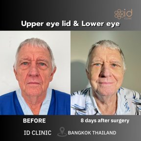 Resultados de blefaroplastia antes y después en ID Clinic Bangkok, párpados superior e inferior