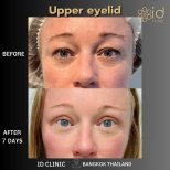 Resultados de blefaroplastia de párpado superior antes y después en ID Clinic Bangkok tras 7 días