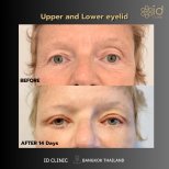 Resultados de blefaroplastia superior e inferior en ID Clinic Bangkok, 14 días después