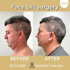 Before and after facelift results at ID Clinic Bangkok, visible jawline and neck tightening