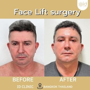 Facelift before and after results at ID Clinic Bangkok, visible facial rejuvenation outcome