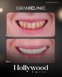 Before and after results of zirconia dental bridge at Grand Clinic for Hollywood Smile