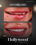 Before and after results of Hollywood Smile with zirconia dental bridge at Grand Clinic