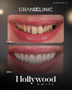 Before and after Hollywood Smile with zirconia dental bridge results at Grand Clinic