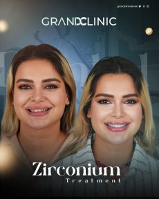 Before and after zirconia dental bridge results at Grand Clinic, improved smile transformation