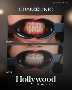 Before and after zirconia dental bridge results at Grand Clinic for Hollywood Smile transformation