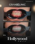 Before and after zirconia dental bridge results at Grand Clinic for Hollywood Smile transformation