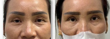 Before and after upper and lower eyelid surgery results – reduced eyelid sagging