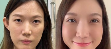 Before and after upper and lower eyelid surgery results – refreshed eye appearance