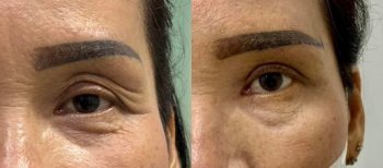 Before and after upper and lower eyelid surgery results – reduced eye wrinkles and bags
