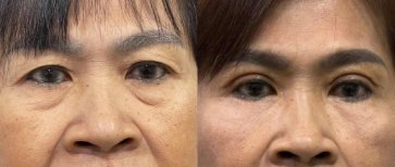 Before and after upper and lower eyelid surgery results – reduced eye bags and smoother skin