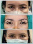 Upper and lower eyelid surgery before and after results – rejuvenated eye appearance