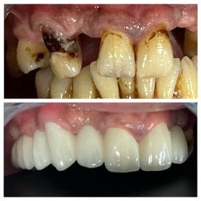 before-after photo all-on-6-dental-implants