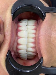 before-after photo all-on-6-dental-implants