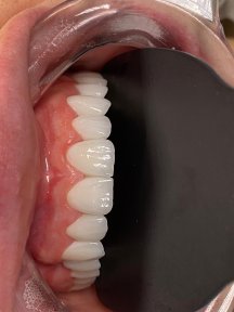before-after photo all-on-6-dental-implants