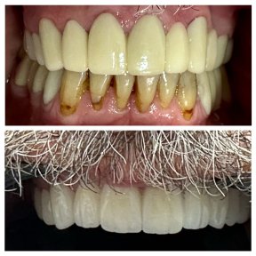 before-after photo hollywood-smile