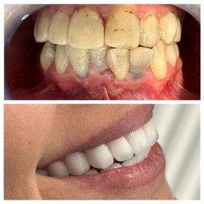 before-after photo hollywood-smile
