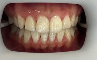 before-after photo hollywood-smile