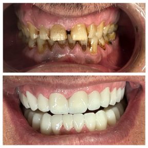 before-after photo hollywood-smile