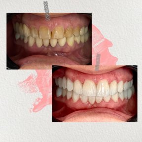 before-after photo hollywood-smile