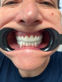 before-after photo hollywood-smile