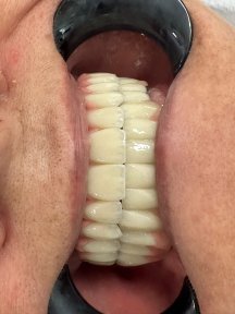 before-after photo hollywood-smile