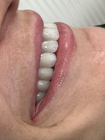 before-after photo smile-makeover