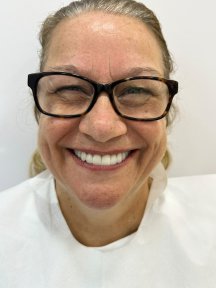 before-after photo smile-makeover