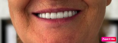 before-after photo smile-makeover