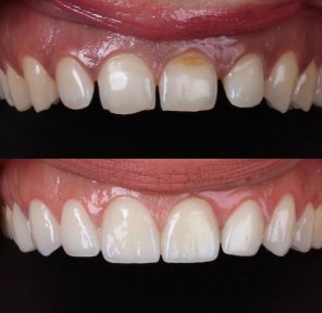 before-after photo zirconia-crown-installation