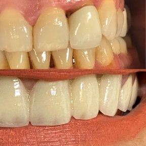 before-after photo zirconia-crown-installation