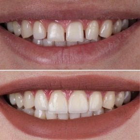 before-after photo zirconia-crown-installation
