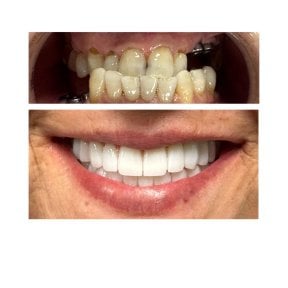before-after photo zirconia-crown-installation