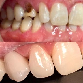 before-after photo zirconia-crown-installation